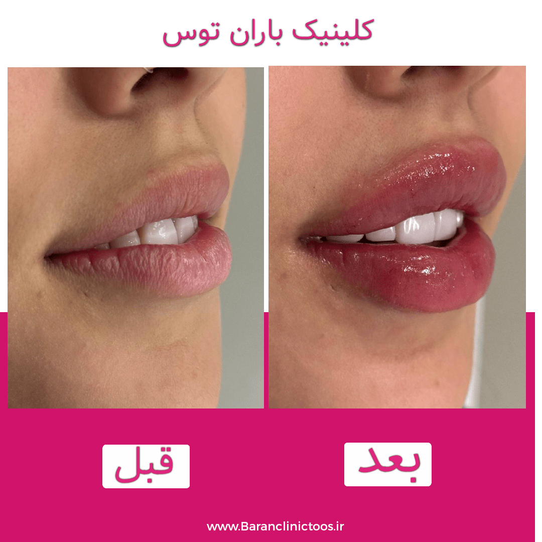 قبل و بعد فیلر لب